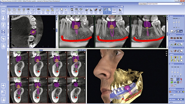 Les Implants - Illustration 1